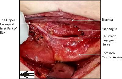 Clinical advantages and neuroprotective effects of monitor guided fang’s capillary fascia preservation right RLN dissection technique